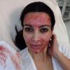 Любимата козметична процедура на Ким Кардашиян зарази три жени с ХИВ