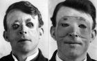 Уолтър Йео - един от първите хора, които претърпява сериозна пластична хирургия и трансплантация на кожа. 1917 г.