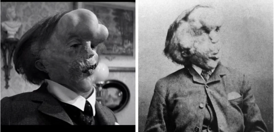 John Hurt: Joseph Merrick, "The Elephant Man"